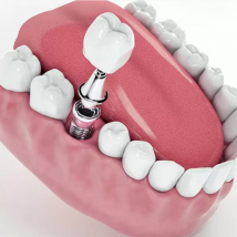 İmplant Tedavisi İmplant Tedavisi