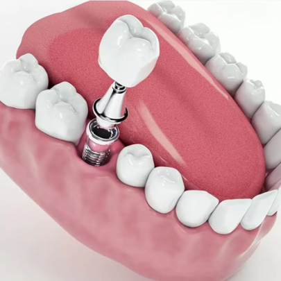 İmplant Tedavisi İmplant Tedavisi